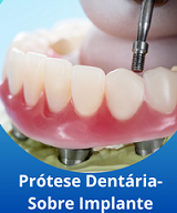 Prótese Dentária sobre Implante Contagem no Eldorado